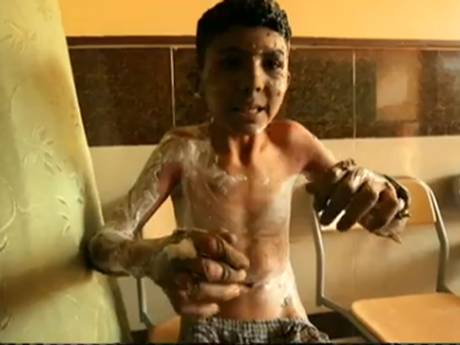 Ahmed, âgé de 15 ans, parmi les brûlés